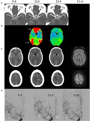 Frontiers | Continuous Intraarterial Nimodipine Infusion for the